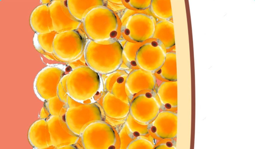 Amas graisseux localisés