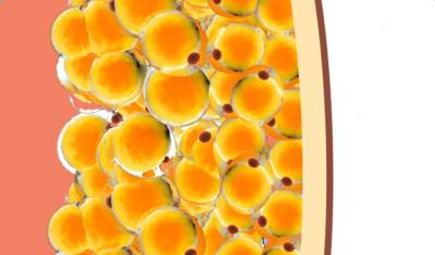 Amas graisseux localisés